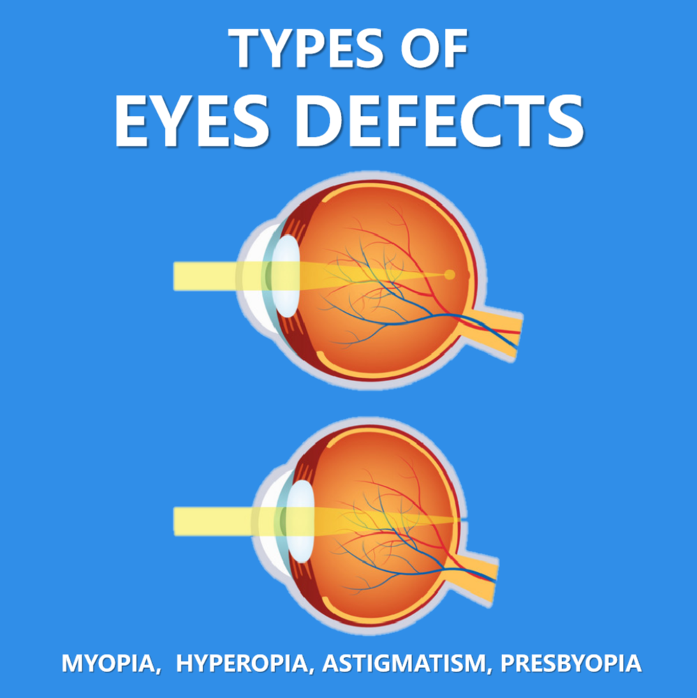 What Are the Different Types of Myopia?